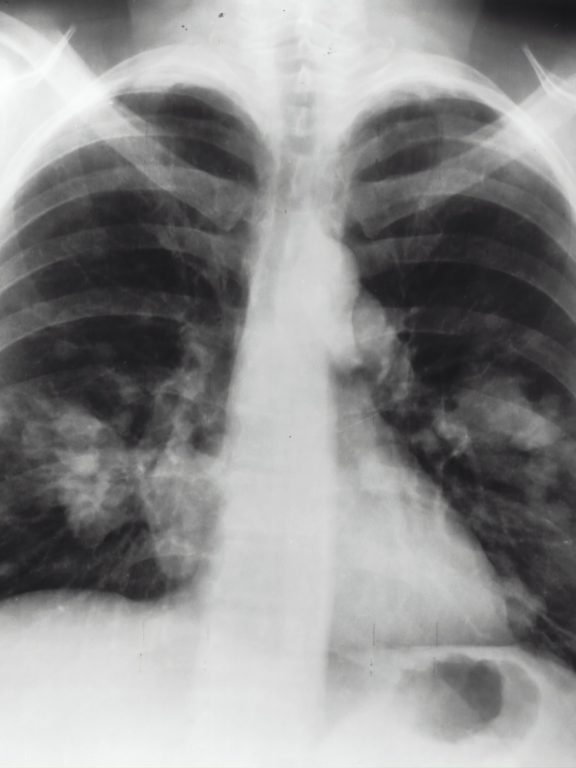 What Happens After a Lung Cancer Diagnosis?