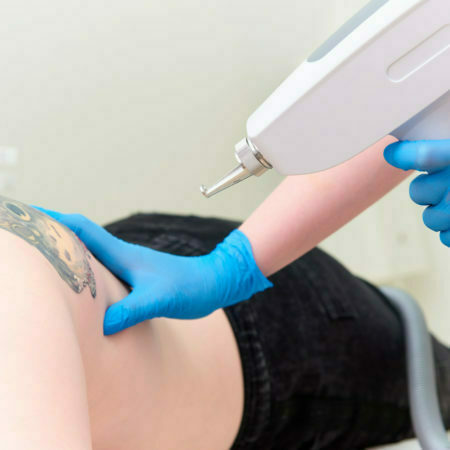 Tattoo removal in the clinic